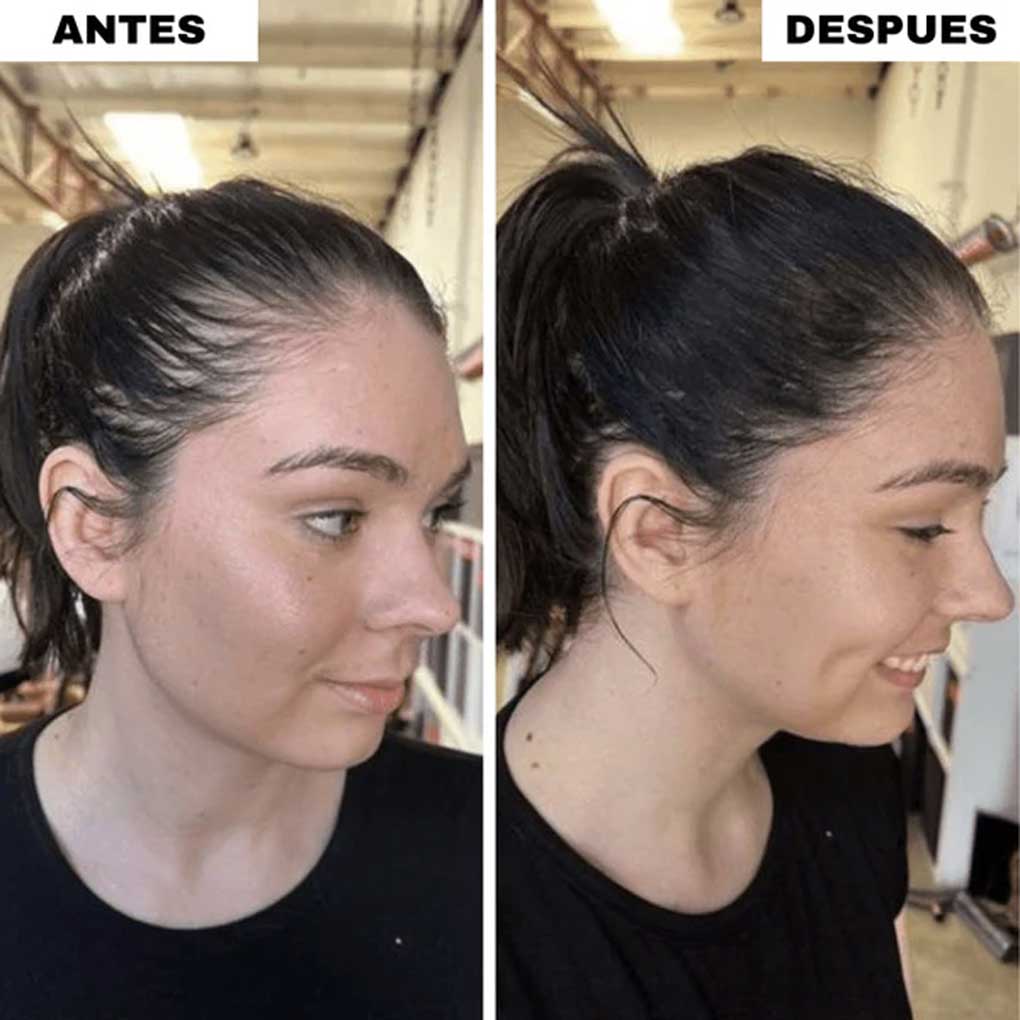 Relleno Capilar Instantáneo Calvicie